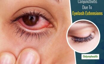 How is an Allergy to Eyelash Extensions Diagnosed and Treated