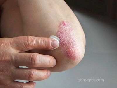Treatment of Peeling Skin on the Elbows