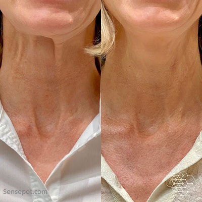 how to remove neck wrinkles at home