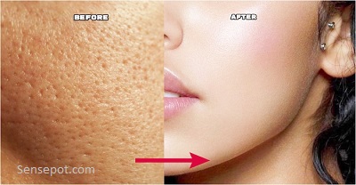 how to shrink pores permanently