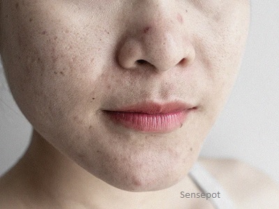 What is Skin Sebum