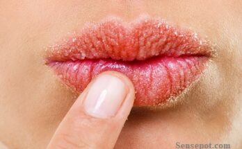 Causes of Weathered Lips